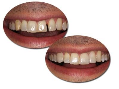 3 EasySmile Veneers to close space and correct discoloration on canine....1 short visit!