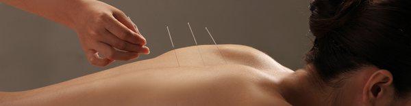 Acupuncture