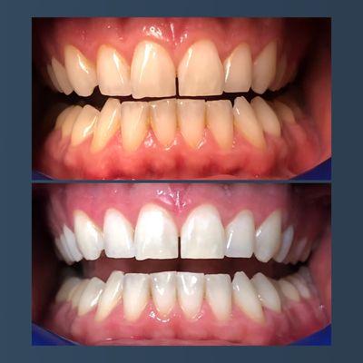 Instant results using dental grade whitening!