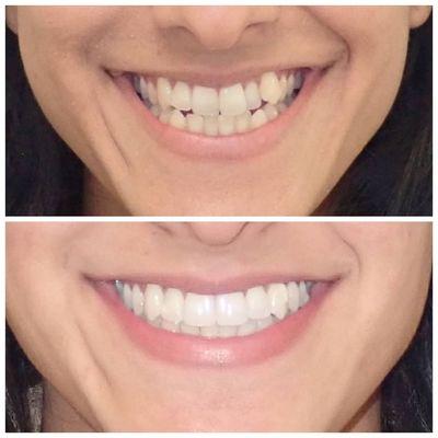 smile transformation