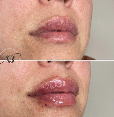 Nurse B injected 1 syringe of Juvederm Ultra to create the perfect pout for our #nubeauty