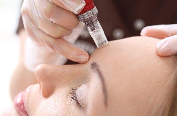 Micro-Needling