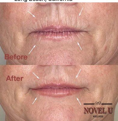 Smoker line correction with dermal fillers