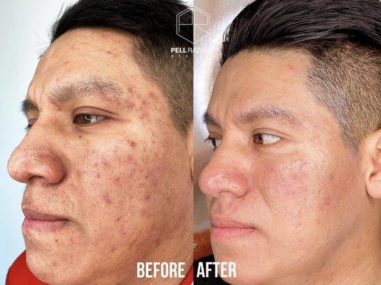 We bring your confidence back! NO more acne or scars