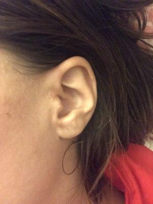 Before and after of accessory tragus removed by Dr. Fisher