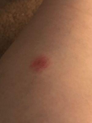 Bed bug bite 2 days after