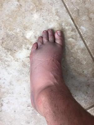 My destroyed foot. They felt that this foot, that can not hold any weight and has its own heartbeat, did not warrant pain meds. Comical.