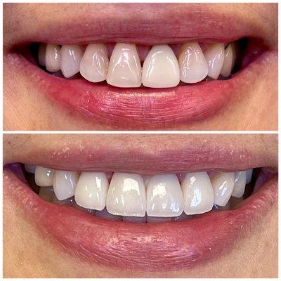 Smile transformation with porcelain veneers!