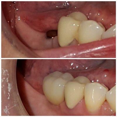 Lower implant molar, Dr Thanh-Duc 2015