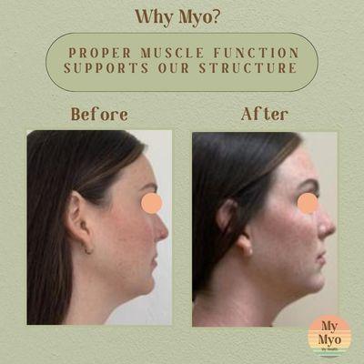 A proper and functional relationship with our orofacial muscles has a direct effect on the shape and structural foundation of our face.