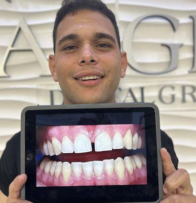 Invisalign happy patient !