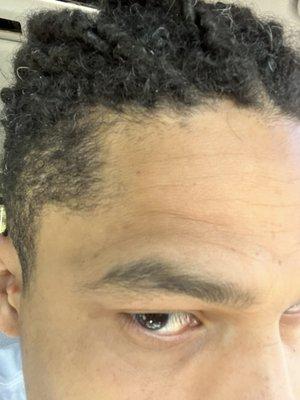 This is the new growth after the barber destroyed my hairline after I repeatedly asked him not to dig into my hairline