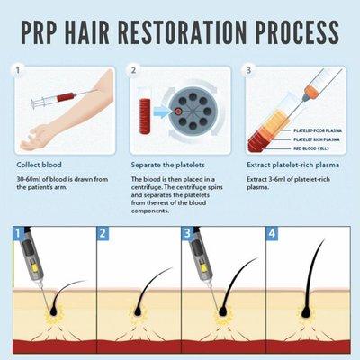 Non-surgical treatment that restores lost volume.