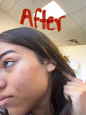 After face reality and monthly/3 month chemical peel