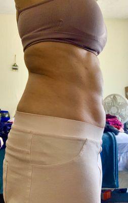 Fat deposits remaining after lipo making my abdomen looking uneven and wavy