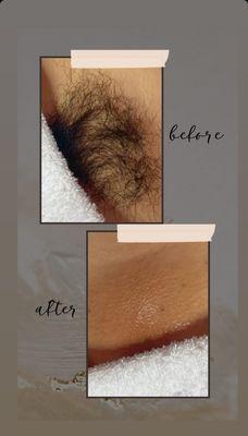 Brazilian before and after Sugar waxing