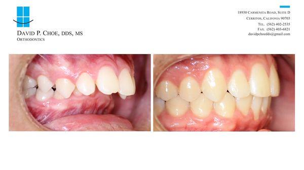 Class II Malocclusion