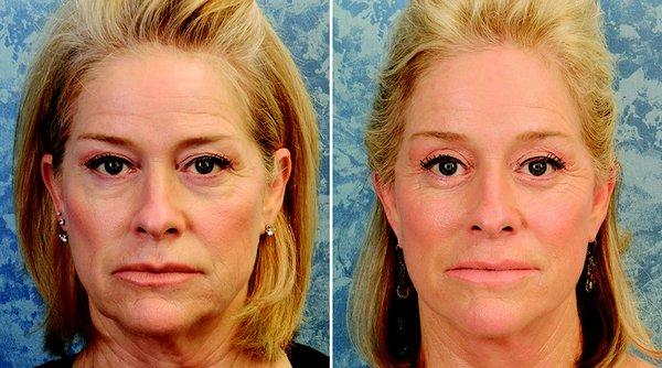 Brow Lift - Face Lift