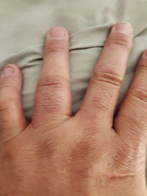 Ring finger deformation