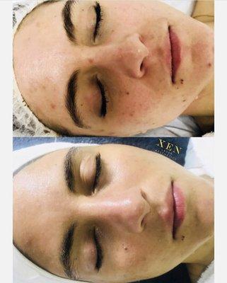 Before AND After six series of Customized Services: Chemical Peels, X-Factor Facial and Vamp Facial (Microneedling)