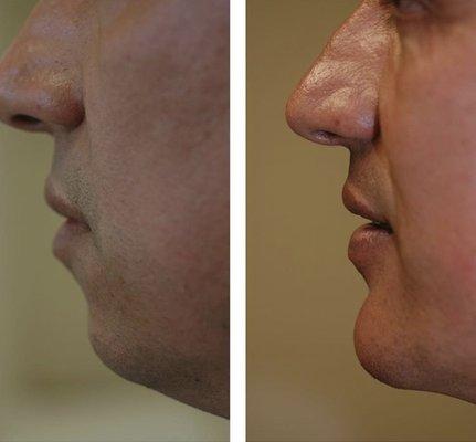 Chin augmentation