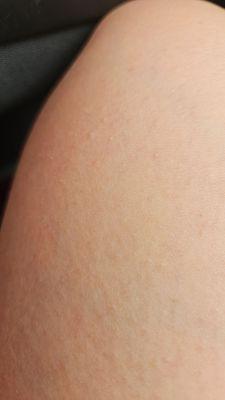 My leg with the rash 45 min after the shower I took in the "clean" bathtub