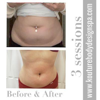 Modern  Lipo, no pain, non invasive treatment