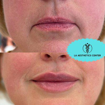 Skin Rejuvenation and Lip artistically augmented, Getting rid of fine lines.