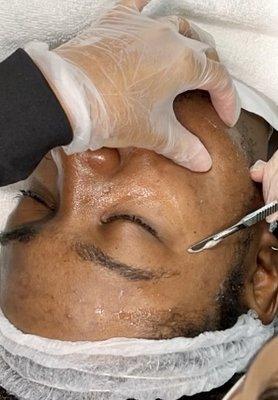 Dermaplaning facial