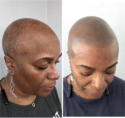 Scalp Micropigmentation Alopecia