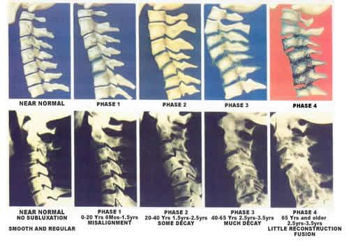 This is a chart of various stages of joint and tissue degeneration.  We specialize in helping people with these problems.