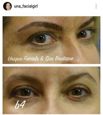 Microblaiding by Unique Facials