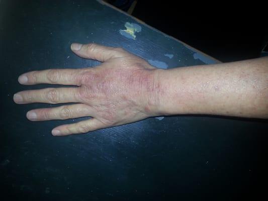 Eczema, before treatment