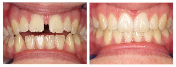 Another amazing Invisalign case. Let us help you!