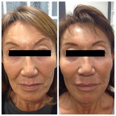 Tox and filler in the cheeks and lips