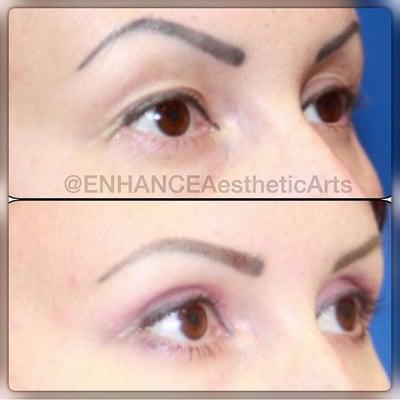 Upper Lid Blepharoplasty