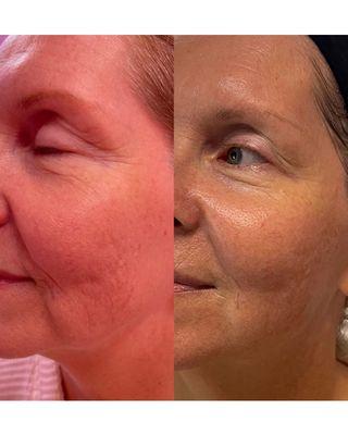 3 Advanced Plasma Treatments, 2 Age Defying Facials