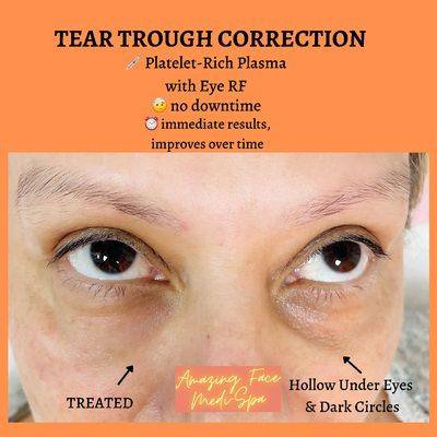 Under eye rejuvenation using PRP