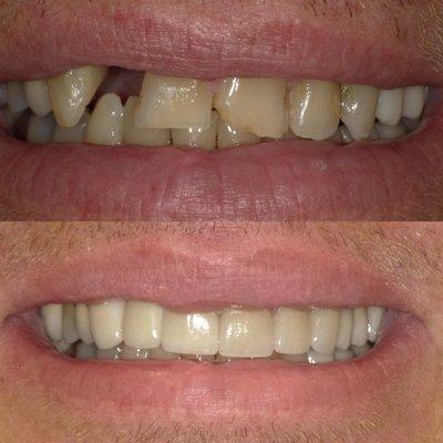 Smile Transformation Before and After- Dr. Thomas Dooley Cedar Village Dentistry