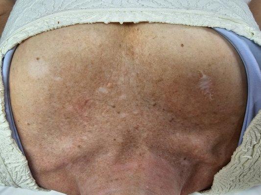 Before IPL the texture looked rough and years of sun damage had her covering up her beautiful chest.