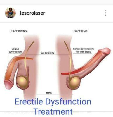 Erectile dysfunction reversed with PRP