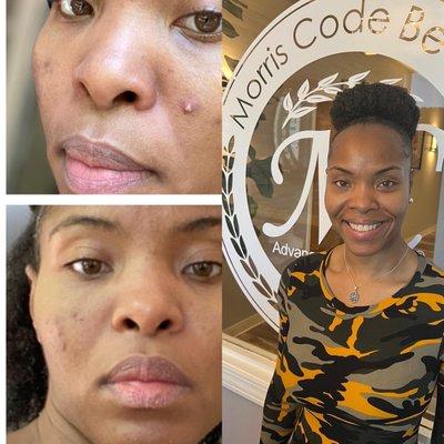 Real Customers - Real Results using Morris Code Beauty® Advanced Aesthetics Skin Care Products & Services!