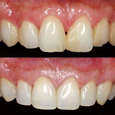 Before and After cosmetic bondings