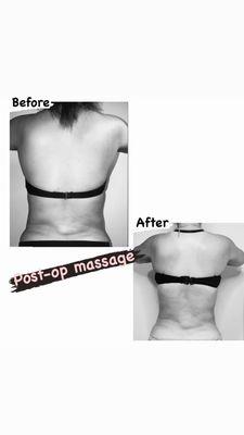 Post-Op Massage!! 
Liposuction 
Lipo- Smart