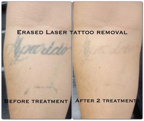 After the 2nd treatment. Erased Tattoo Removal Las Vegas www.erasedlasertattooremoval.com