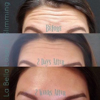 Smoother forehead in 2 weeks with Botox!