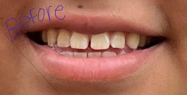 My teeth before