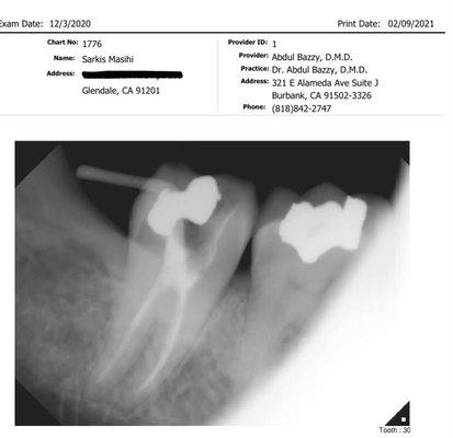 Proof Of Root Canal.