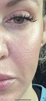 After microneedling. Rough texture. Pits in my face. Loss of elasticity. Large pores everywhere. Just chewed up.