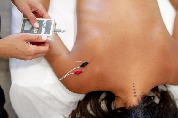 Electroacupuncture in San Diego